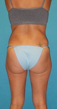 After Image: Brazilian Butt Lift: Case 3 - back