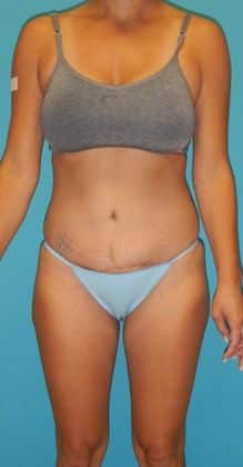 After Image: Brazilian Butt Lift: Case 3 - 
