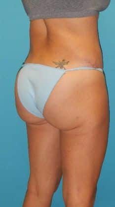 After Image: Brazilian Butt Lift: Case 3 - 