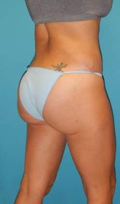 After Image: Brazilian Butt Lift: Case 3 - right-back-oblique