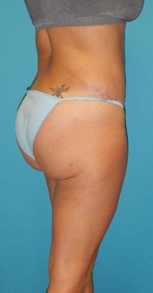 After Image: Brazilian Butt Lift: Case 3 - right-back-oblique
