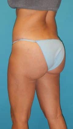 After Image: Brazilian Butt Lift: Case 3 - left-back-oblique