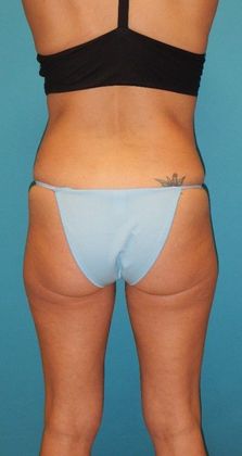 Before Image: Brazilian Butt Lift: Case 3 - back