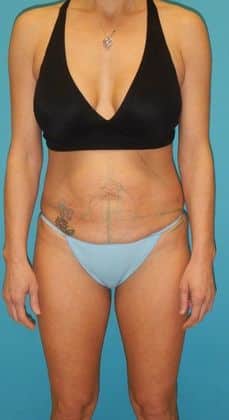 Before Image: Brazilian Butt Lift: Case 3 - 