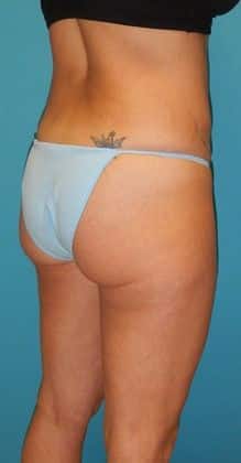 Before Image: Brazilian Butt Lift: Case 3 - 