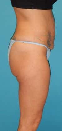 Before Image: Brazilian Butt Lift: Case 3 - 