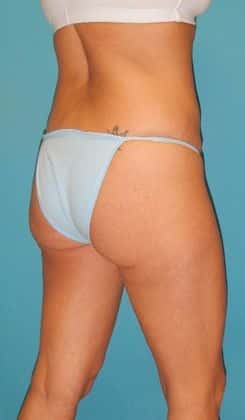 Before Image: Brazilian Butt Lift: Case 3 - right-back-oblique