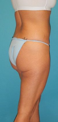 Before Image: Brazilian Butt Lift: Case 3 - right-back-oblique