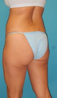 Before Image: Brazilian Butt Lift: Case 3 - left-back-oblique