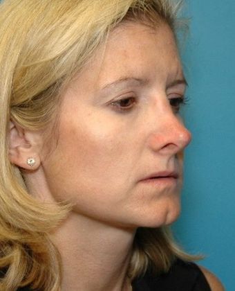 After Image: Soft Tissue Fillers: Case 3 - right-front-oblique