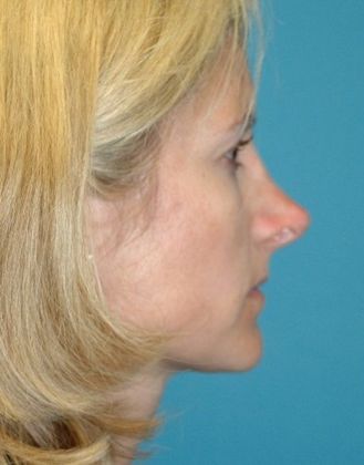 After Image: Soft Tissue Fillers: Case 3 - right-side