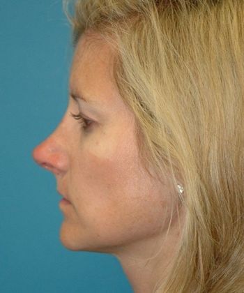 After Image: Soft Tissue Fillers: Case 3 - left-side