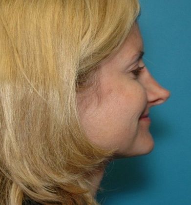 Before Image: Soft Tissue Fillers: Case 3 - right-side