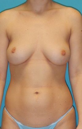 Before Image: Breast Augmentation: Case 3 - front