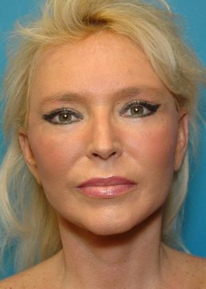 After Image: Fat Grafting Face: Case 3 - front