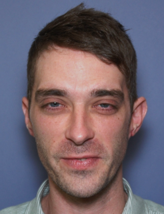 After Image: Otoplasty: Case 3 - front