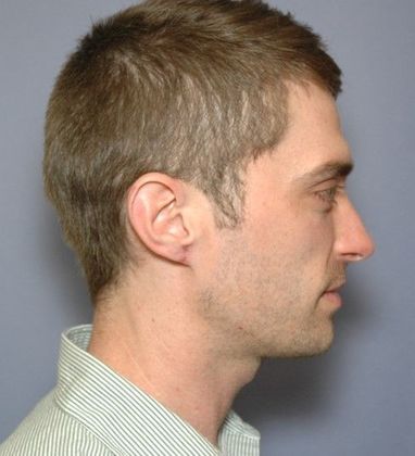 After Image: Otoplasty: Case 3 - right-side