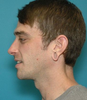 After Image: Otoplasty: Case 3 - left-side
