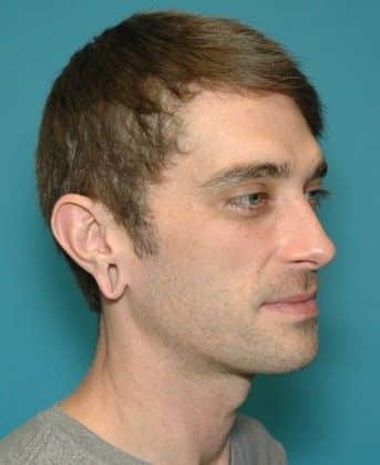 Before Image: Otoplasty: Case 3 - right-front-oblique