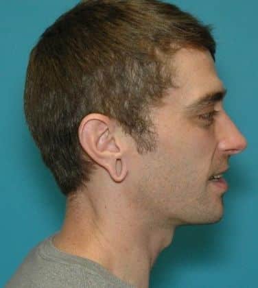 Before Image: Otoplasty: Case 3 - right-side