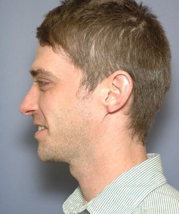 Before Image: Otoplasty: Case 3 - left-side