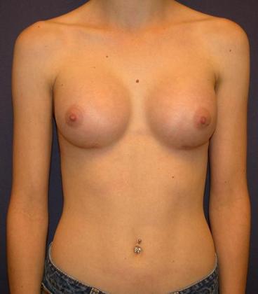 After Image: Breast Augmentation: Case4 - front
