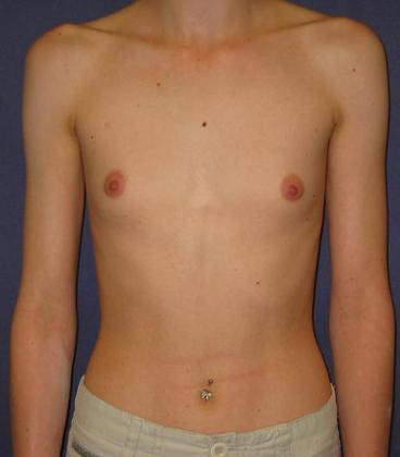 Before Image: Breast Augmentation: Case4 - front