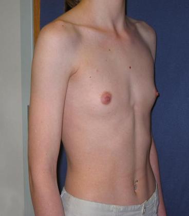 Before Image: Breast Augmentation: Case4 - right-front-oblique