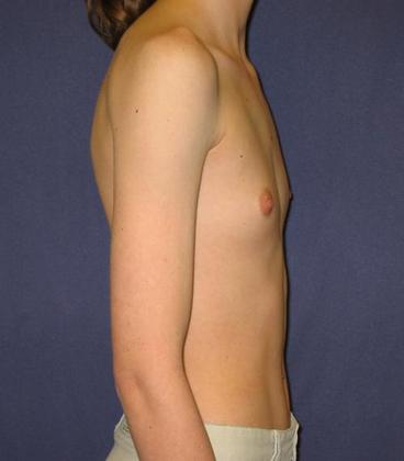 Before Image: Breast Augmentation: Case4 - right-side