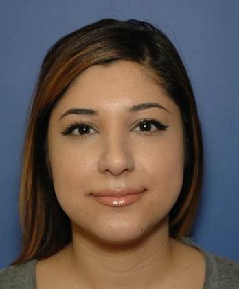 After Image: Rhinoplasty: Case 4 - front