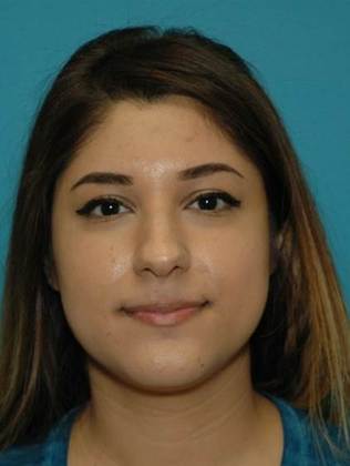 Before Image: Rhinoplasty: Case 4 - front