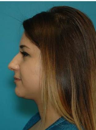 Before Image: Rhinoplasty: Case 4 - left-side