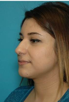 Before Image: Rhinoplasty: Case 4 - left-front-oblique