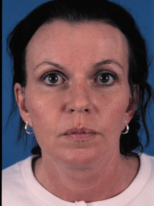 After Image: Face & Neck Lifts: Case-4 - front