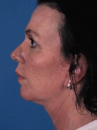 After Image: Face & Neck Lifts: Case-4 - left-side