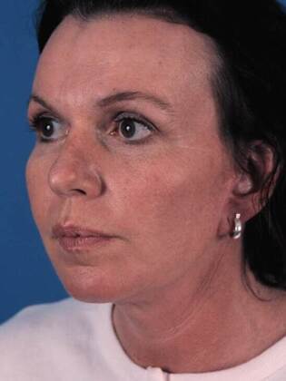 After Image: Face & Neck Lifts: Case-4 - left-front-oblique