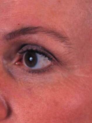 After Image: Face & Neck Lifts: Case-4 - left-front-oblique