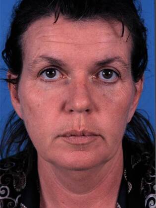 Before Image: Face & Neck Lifts: Case-4 - front
