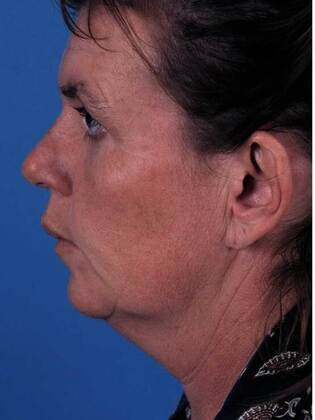 Before Image: Face & Neck Lifts: Case-4 - left-side