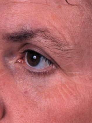 Before Image: Face & Neck Lifts: Case-4 - left-front-oblique