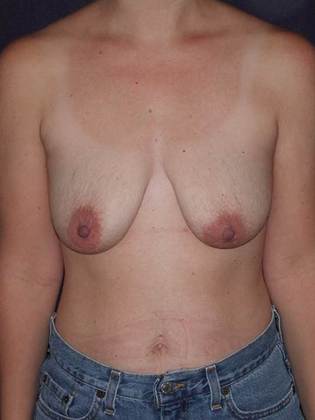 Before Image: Breast Lift Augmentation: Case 4 - front