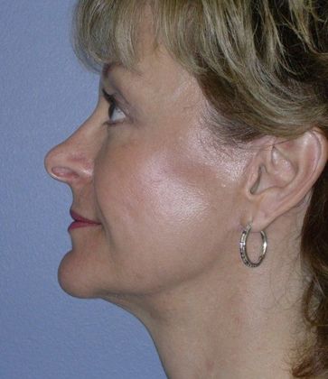 After Image: Mini Facelift: Case 4 - left-side