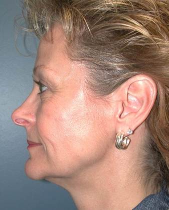 Before Image: Mini Facelift: Case 4 - left-side