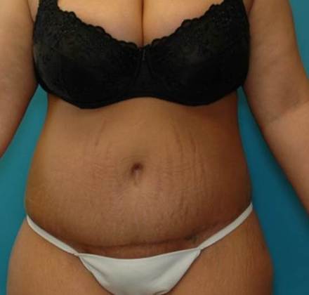After Image: Abdominoplasty: Case4 - front