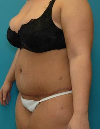 After Image: Abdominoplasty: Case4 - left-front-oblique