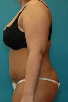 After Image: Abdominoplasty: Case4 - left-side