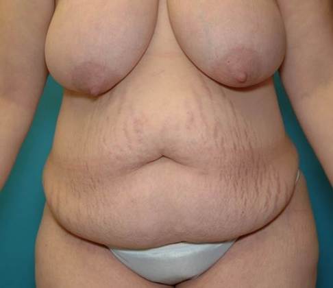 Before Image: Abdominoplasty: Case4 - front