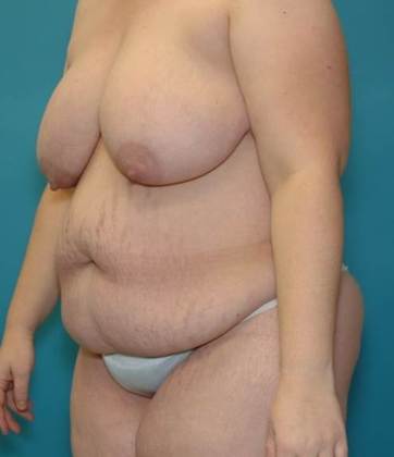 Before Image: Abdominoplasty: Case4 - left-front-oblique