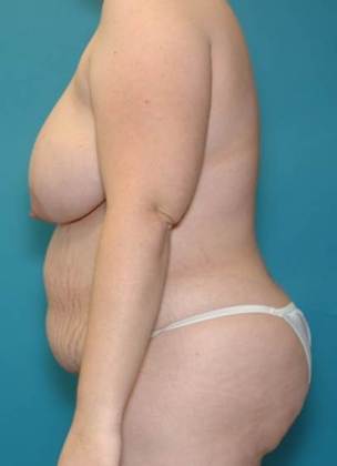 Before Image: Abdominoplasty: Case4 - left-side
