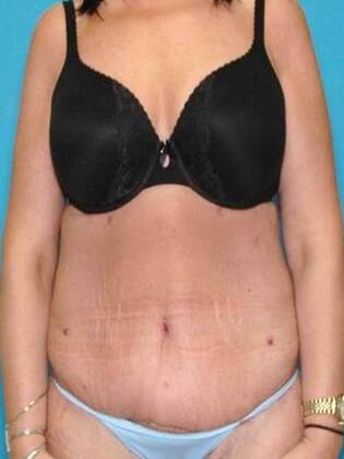 After Image: Abdominoplasty: Case4 - front